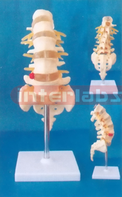 LUMBAR VERTEBRAE WITH SACRUM & COCCYX AND HERNIATED DISC